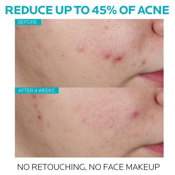 La Roche Posay Effeclar Sa Acne Treatment Serum 1.0 fl. oz.(30ml) - Image 3 of 6