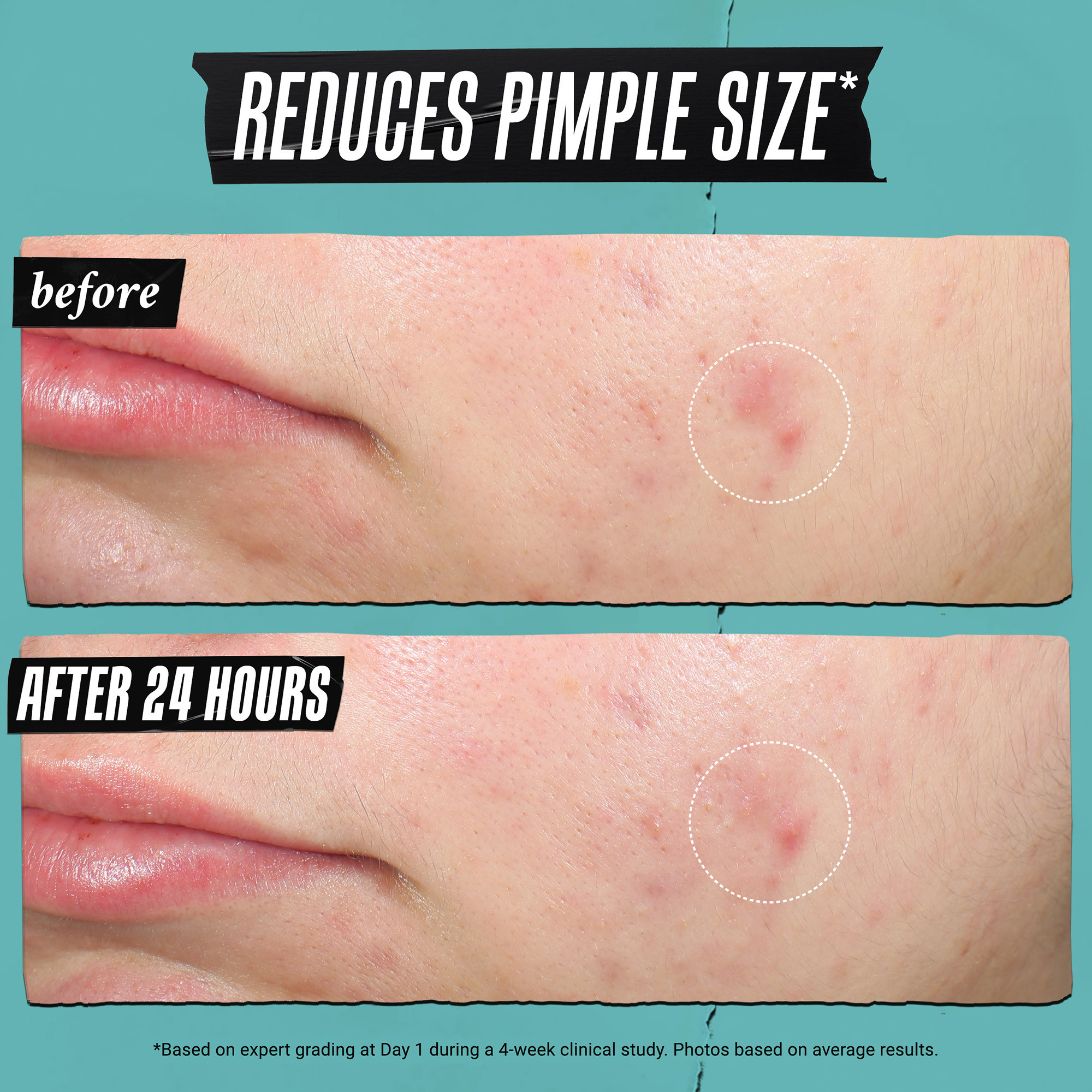 Kiehl's Truly Targeted Acne-clearing Pimple Patch 0.5 fl. oz.(15ml) - Image 2 of 8