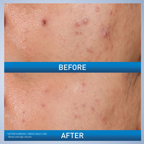 CeraVe Acne Control Gel 1.35 fl. oz.(40ml) - Image 3 of 6