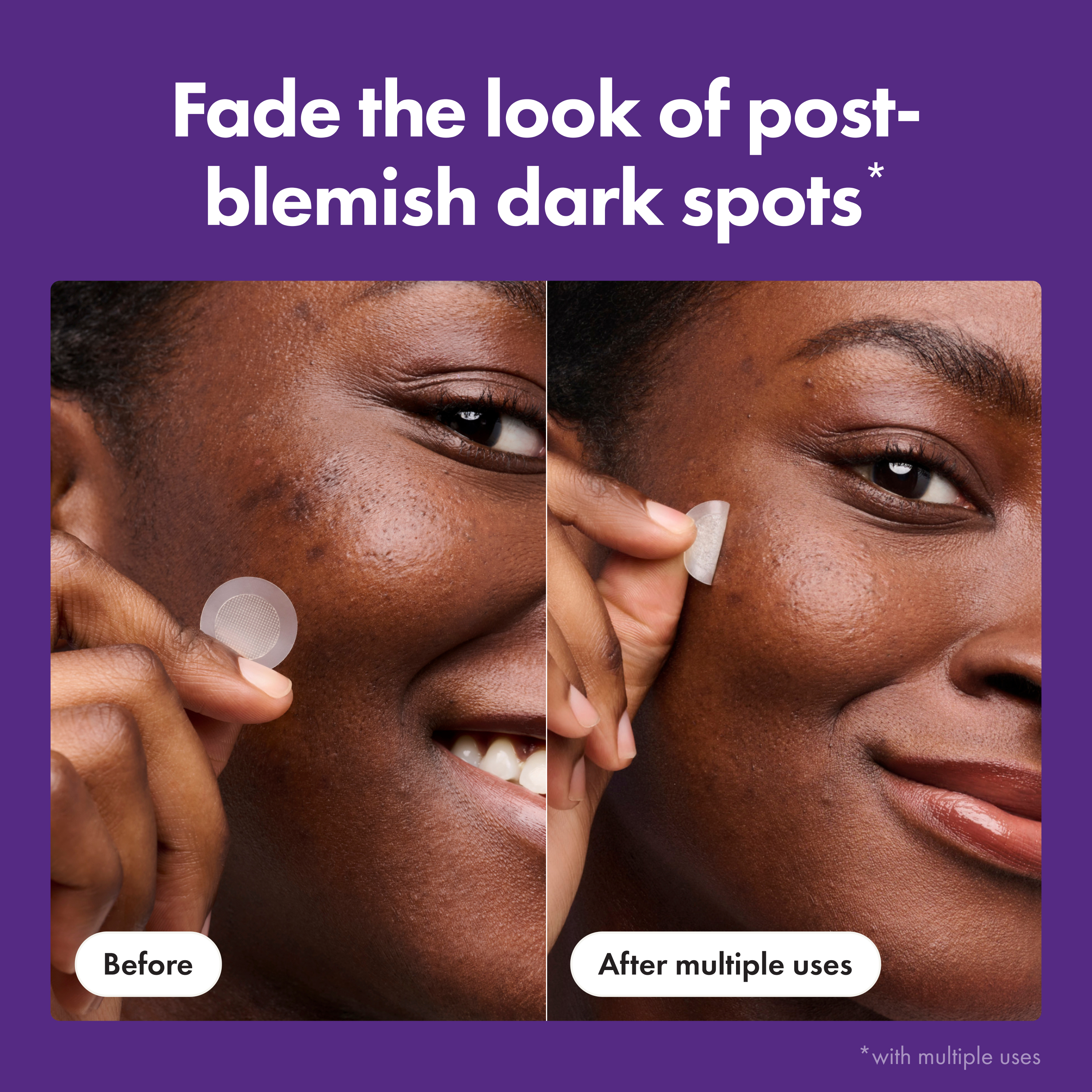 HERO Cosmetics Mighty Patch Micropoint for Dark Spots 8patches detail 3