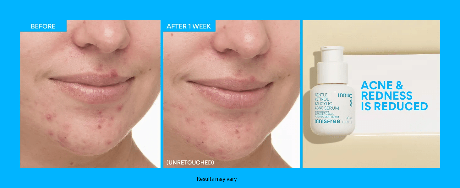 innisfree Gentle Retinol Salicylic Acne Serum 1.01 fl. oz.(30ml